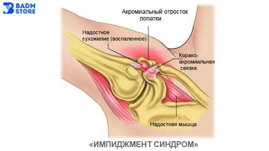 Импиджмент-сиднром в бадминтоне