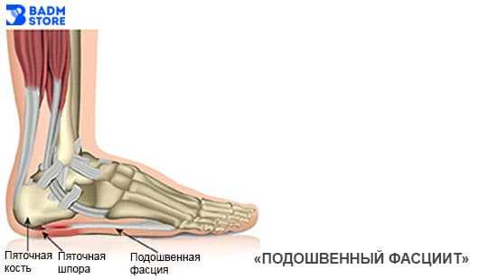 Подошвенный фасциит в бадминтоне