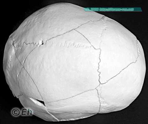 Повреждения черепа при переезде колёсами автомобиля