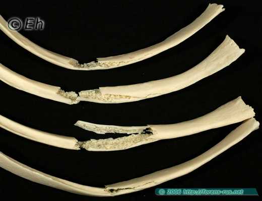 Множественные переломы ребер при переезде