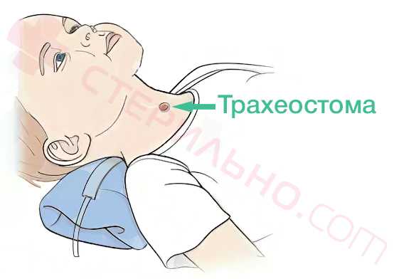 Трахеостома у детей
