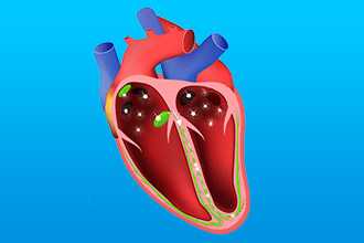 Трепетание предсердий