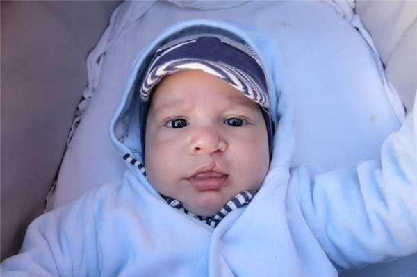 Синдром Патау