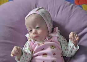 Фото новорожденных c синдромом Эдвардса
