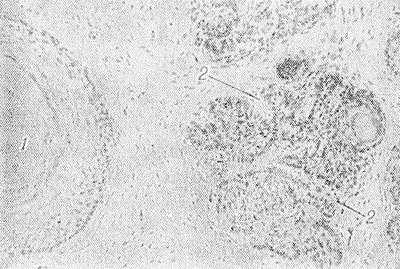 Рис. Микропрепарат трихоэпителиомы кожи (кистозная форма): 1 — кистозная полость, содержащая роговые массы; 2 — базалиомоподобные разрастания; окраска гематоксилин-эозином; х 160