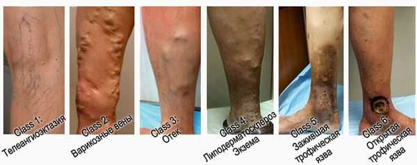 Классы язв по CEAP