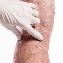 Трофическая язва