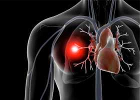 Тромбоэмболия легочной артерии (ТЭЛА)