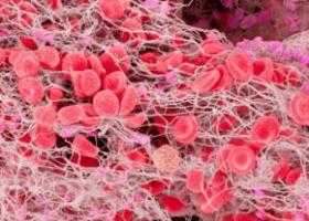 Тромбоэмболия легочной артерии 