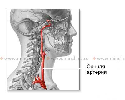 Анатомия общей сонной и внутренней сонной артерии даёт понять механизм возникновения ишемического инсульта.