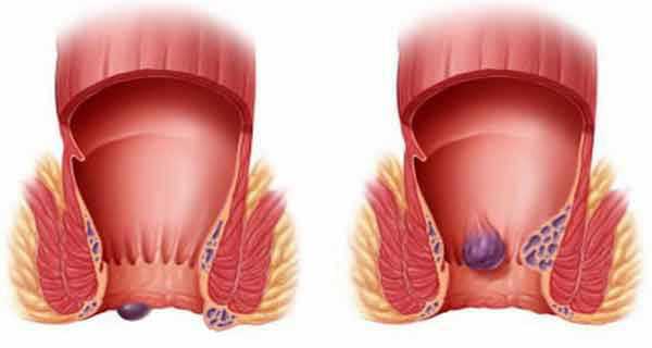 Наружный и внутренний геморрой