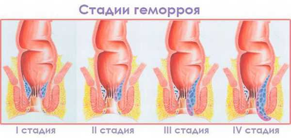 Стадии геморроя