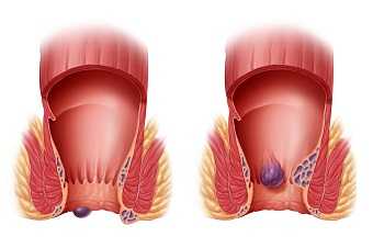 Тромбоз геморроидального узла