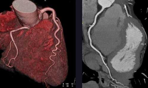 КТ-коронарография