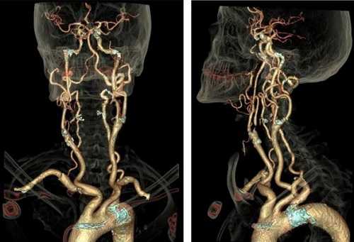 КТА брахиоцефальных артерий