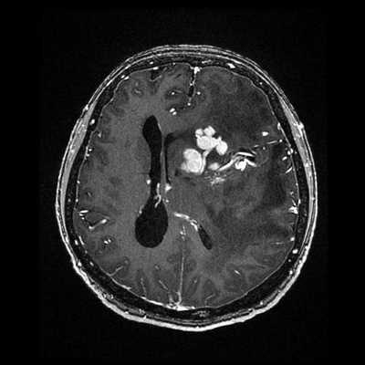 МРТ головного мозга