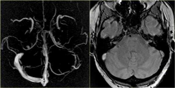 Тромбоз на МРТ