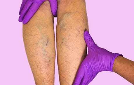 Тромбофлебит