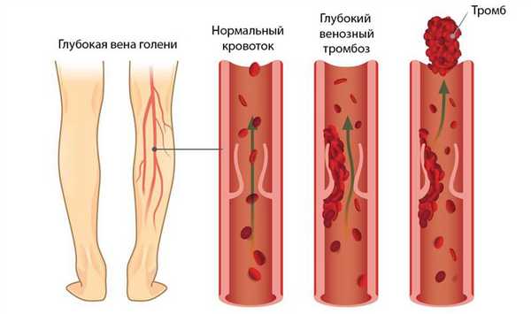 тромбофлебит.jpg