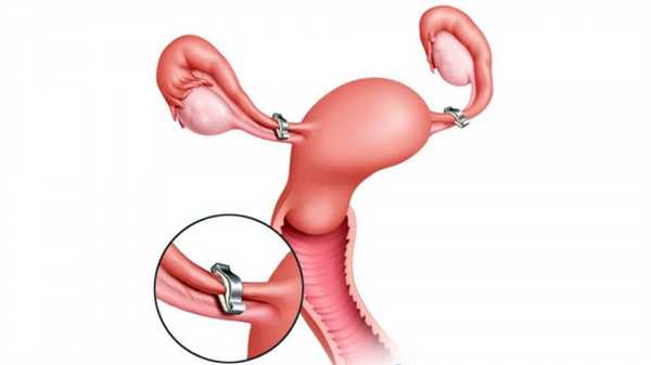 Зажимы на маточных трубах