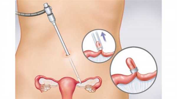 Лапароскопическая хирургическая стирилизация