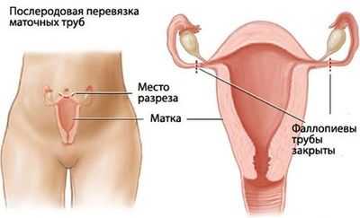 Перевязка маточных труб