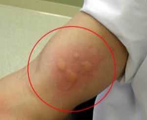 аллергическая реакция на тест