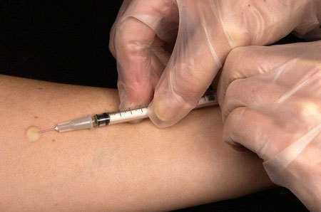 Что такое папула при Манту и какой должен быть размер по годам