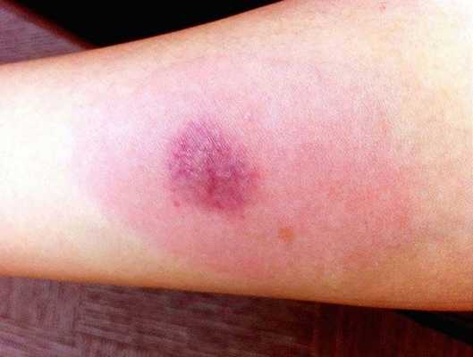 Что такое папула при Манту и какой должен быть размер по годам