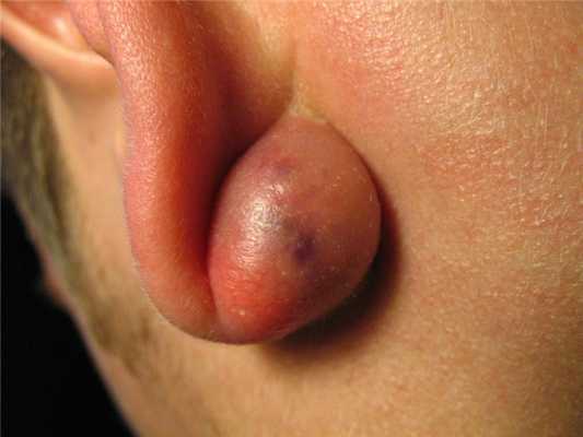 ТУБЕРКУЛЁЗ УХА.jpg