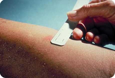 Проба Манту