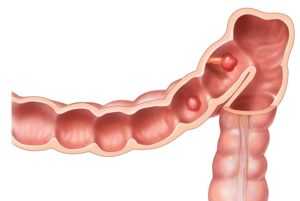 Аденома кишечника