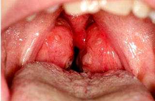 Воспаление миндалин