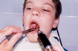 Лечение гланд и миндалин