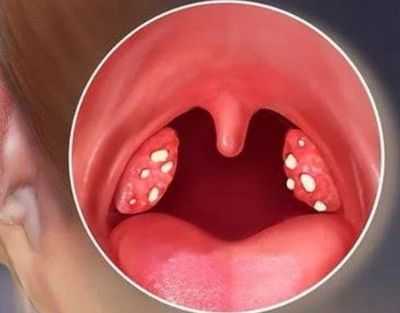 пробки в миндалинах