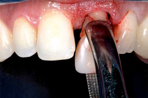 удаление переднего зуба