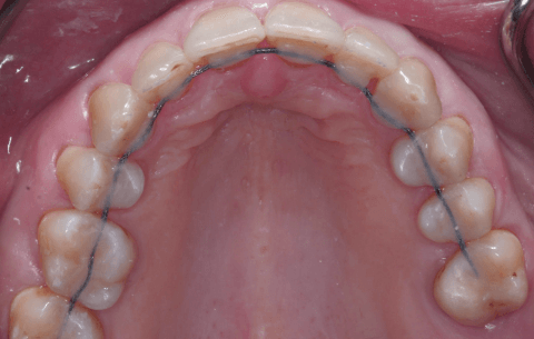 шинирование подвижных зубов что это такое