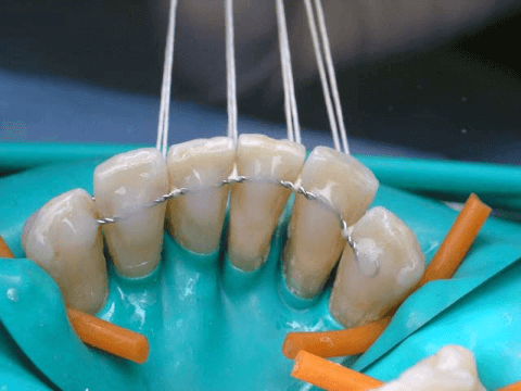 шинирование зубов фото до и после