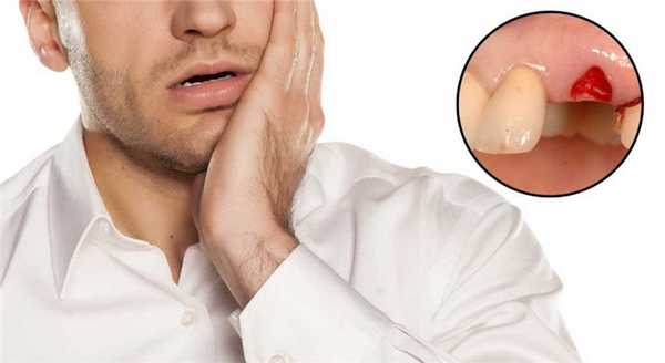 Возможные негативные последствия после удаления зуба