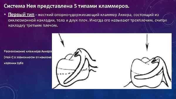 Кламмера системы нея 5 типов