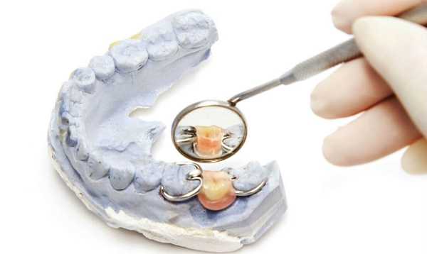 Виды кламмеров и их составные элементы