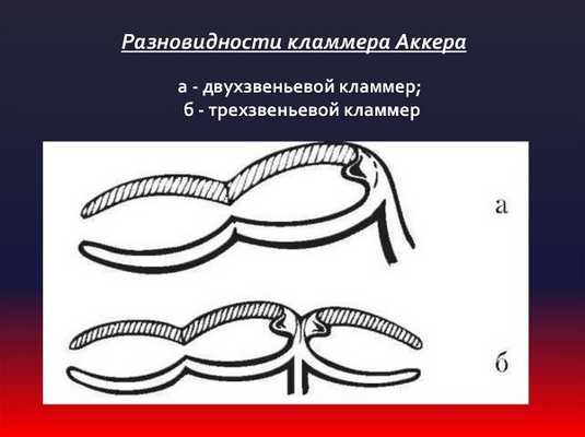 Виды кламмеров в ортопедической стоматологии