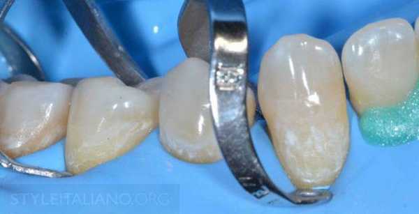 виды кламмеров