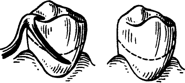 Виды кламмеров и их составные элементы