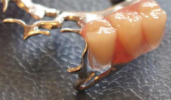 Назначение и принцип работы кламмеров системы Нея