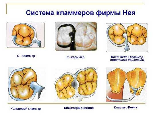 Виды опорно удерживающих кламмеров