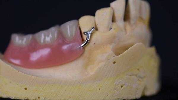 Виды кламмеров в бюгельном протезе