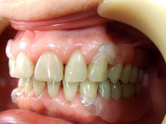 прозрачный кламмер