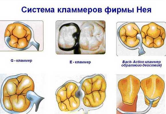 Кламмера по Нею классификация