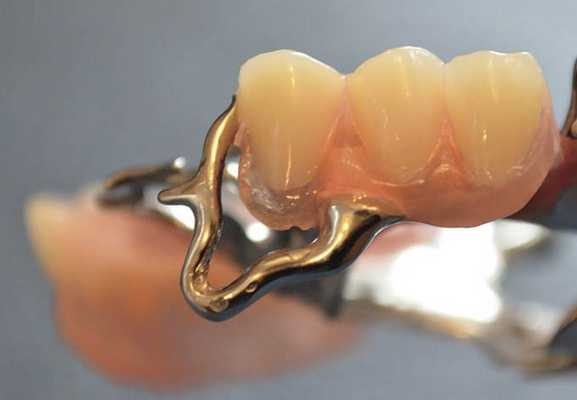 Т-образный кламмер